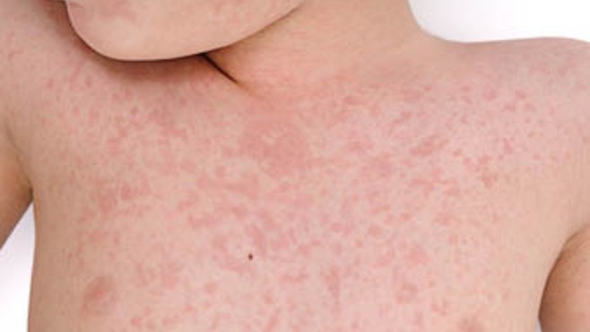 L'agence régionale de Santé alerte sur une circulation active du virus de la rougeole dans les Hauts-de-France