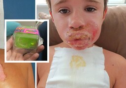 Saint-Omer : un garçon de 8 ans grièvement brûlé après l'explosion d'un jouet anti-stress, sa mère témoigne
