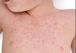 L'agence régionale de Santé alerte sur une circulation active du virus de la rougeole dans les Hauts-de-France